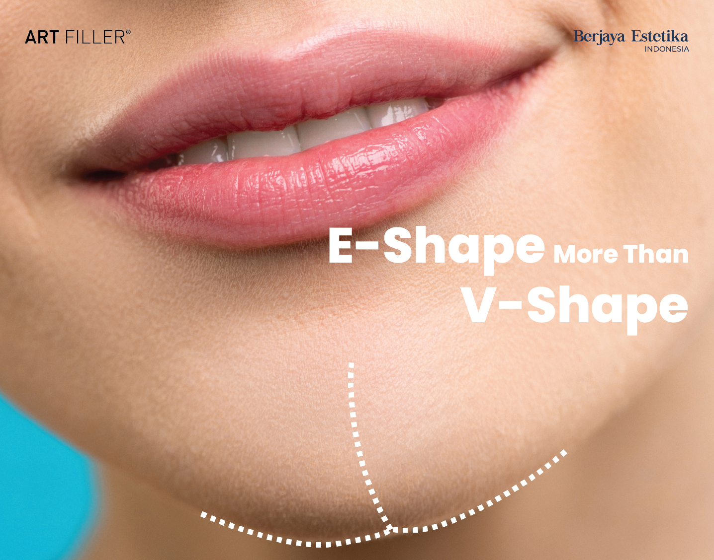 E-Shape Treatment