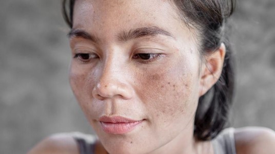 melasma