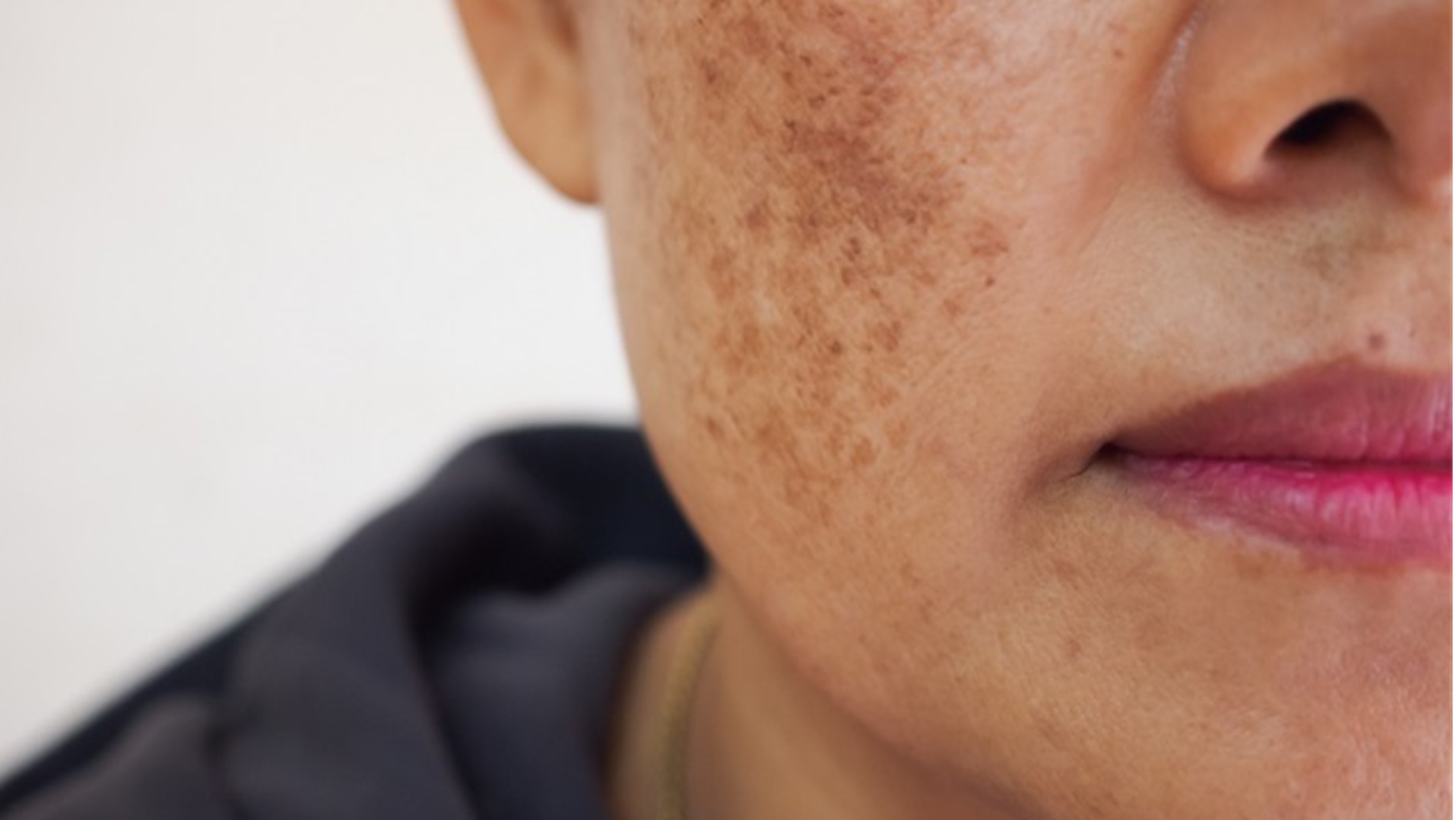 melasma